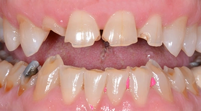 Before mouth reconstruction treatment.
