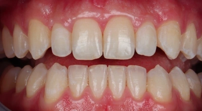 After orthodontic treatment with straighter, properly aligned teeth.