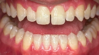 Before orthodontic treatment showing crowded and misaligned teeth.