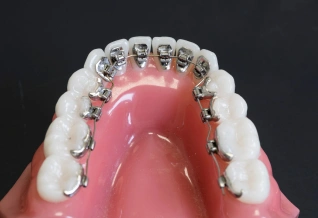 Bonded Retainer