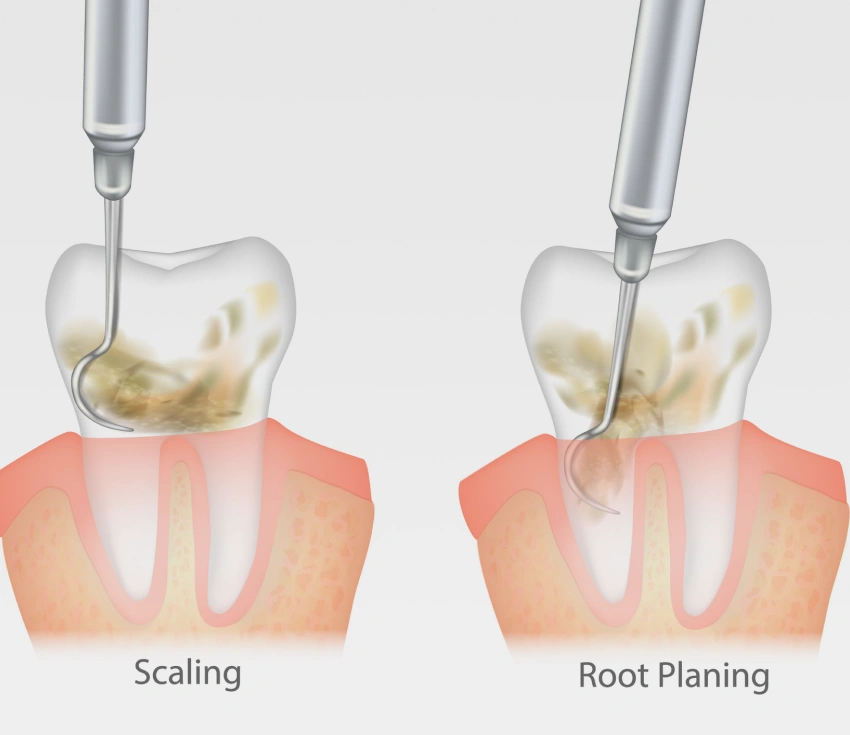 DEEP PERIODONTAL CLEANING