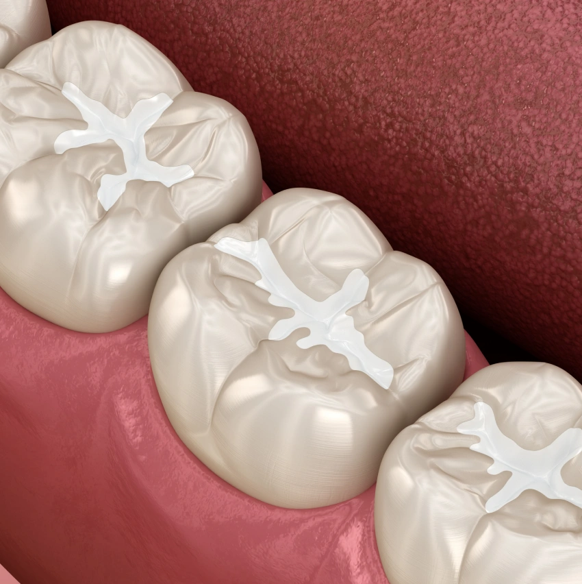 What To Know About Dental Sealants