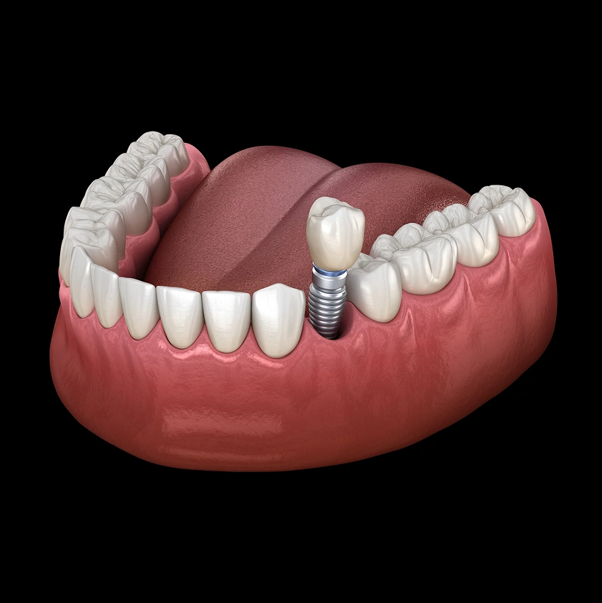Restore Your Smile With a Single Dental Implant