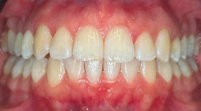 After teeth alignment treatment with straighter teeth.