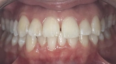 Before teeth alignment treatment showing crowded teeth.