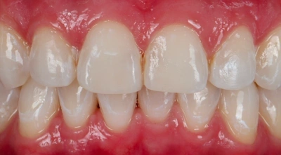 After professional teeth whitening for a brighter smile.