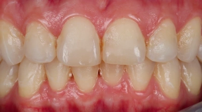Before professional teeth whitening.