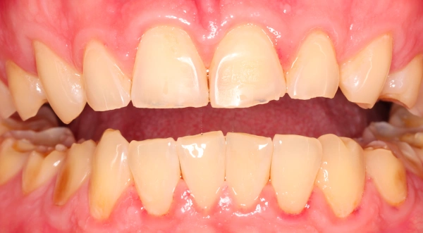 Cosmetic Dentistry Smile Before